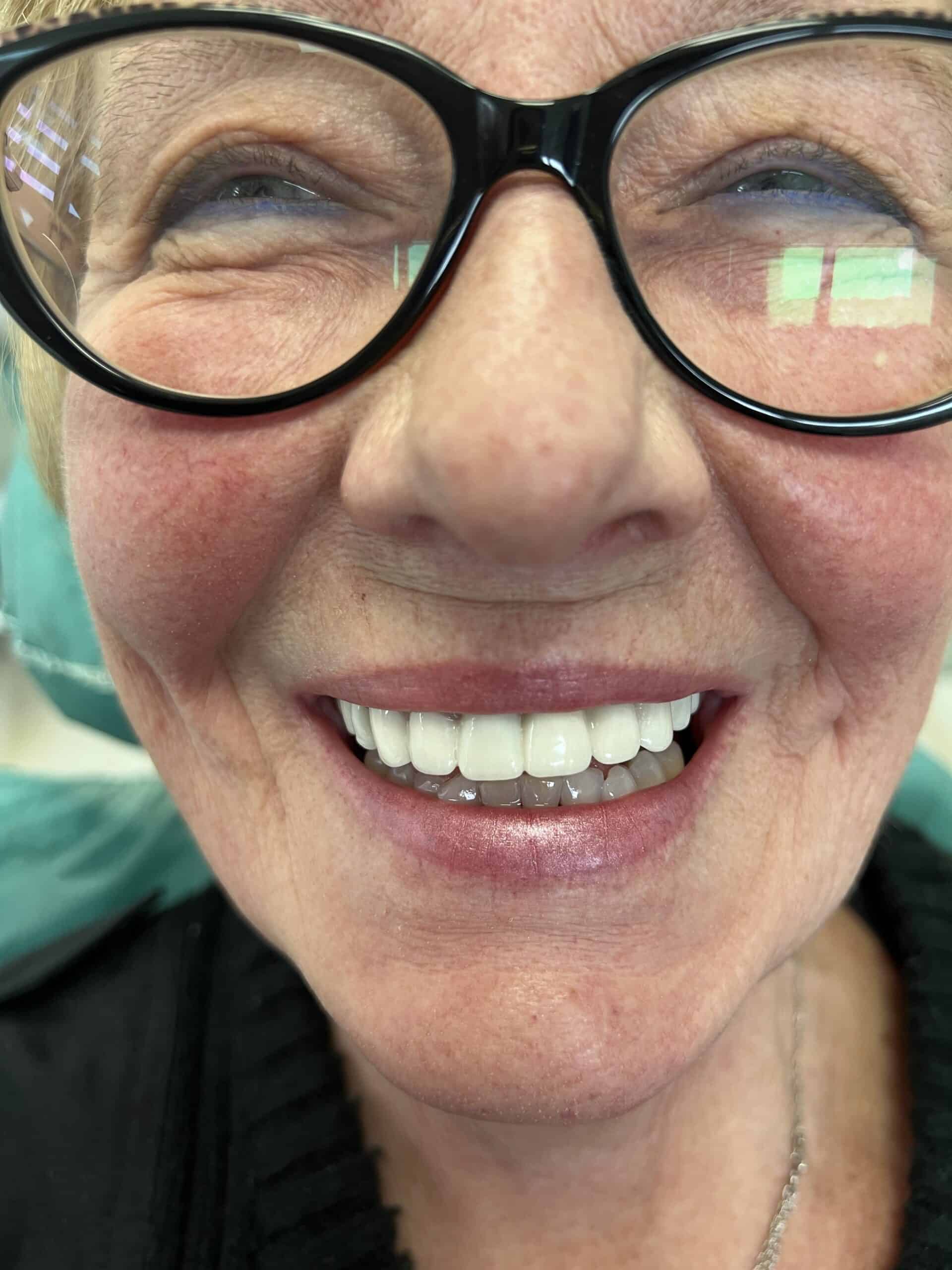 amazing results before and after dental crowns in Albania