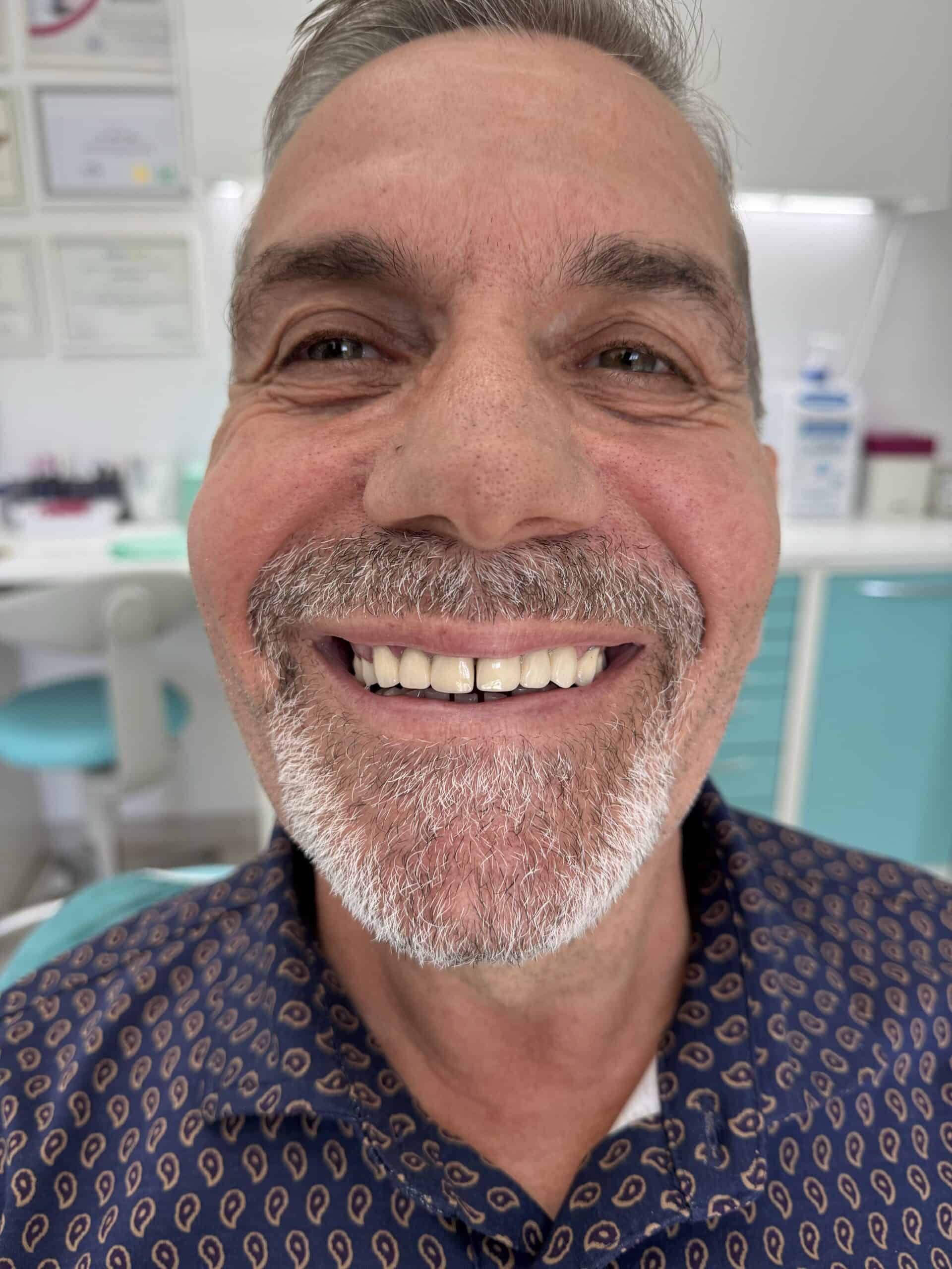 photos before dental crowns in Albania