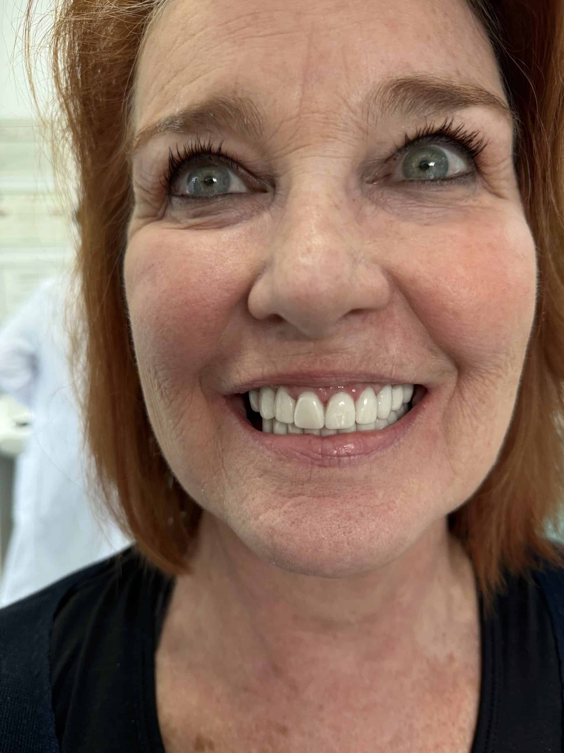 real patient results before and after dental crowns in Albania