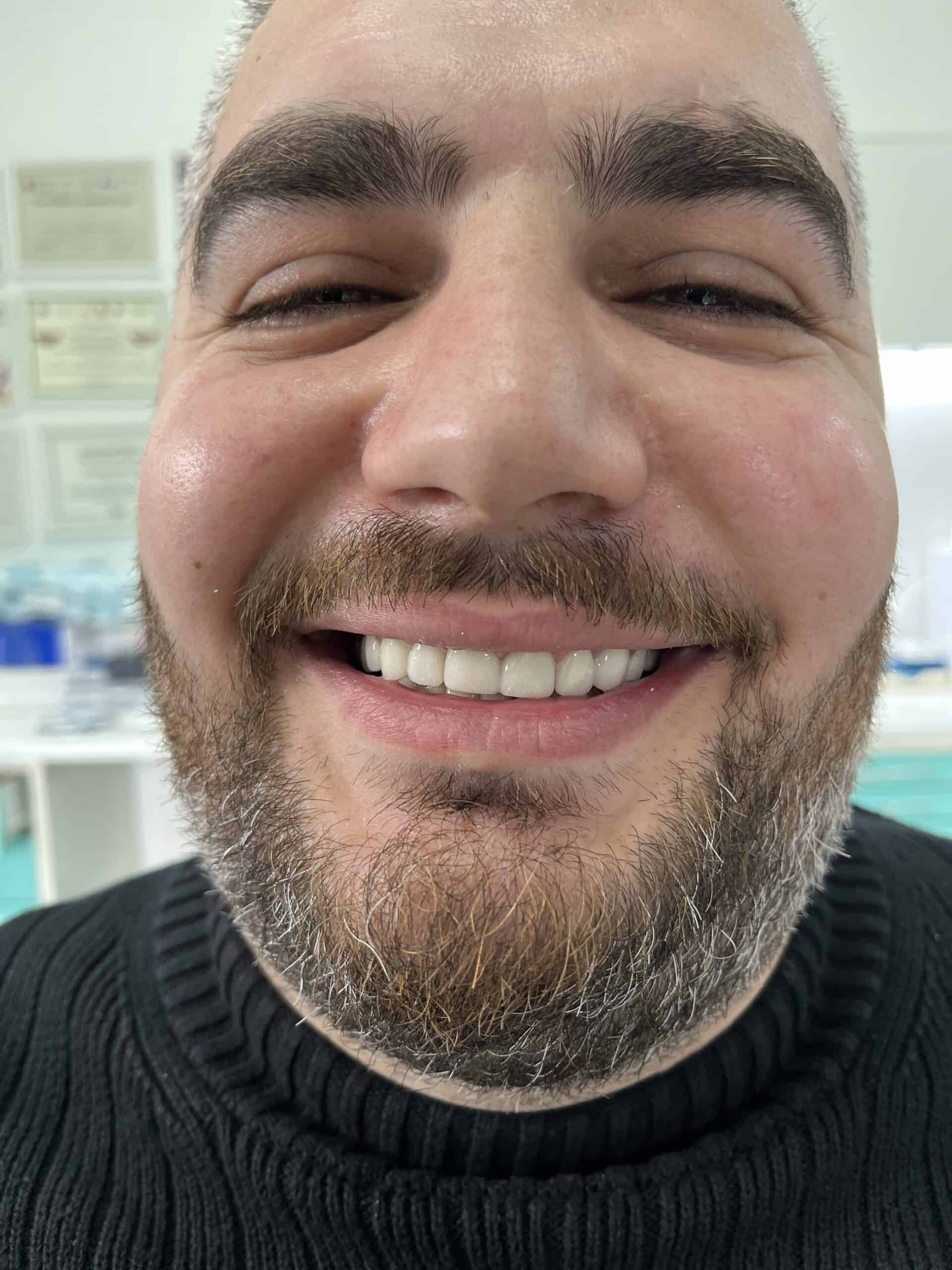 before and after dental crowns in albania