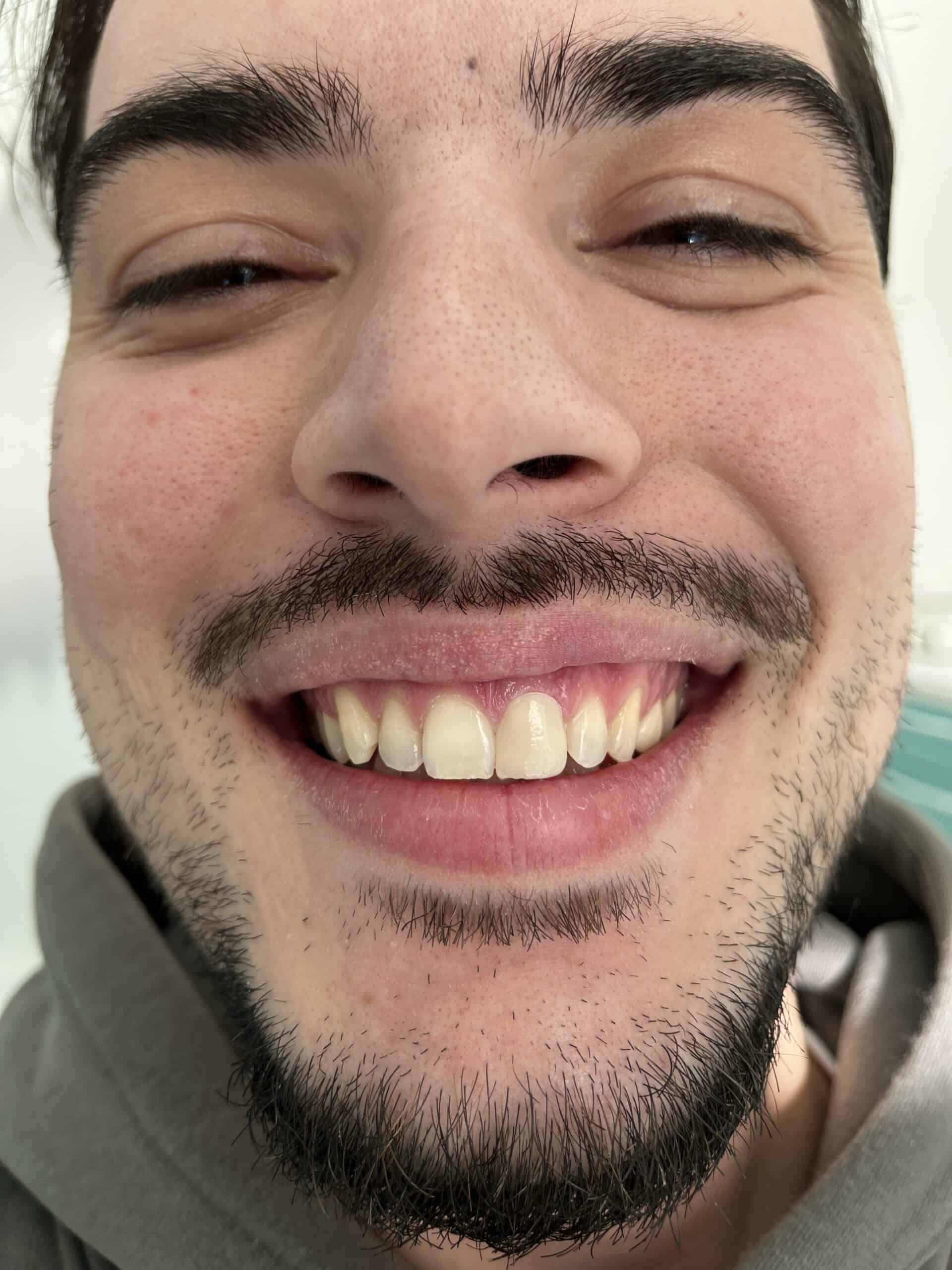 real results dental veneers in Albania
