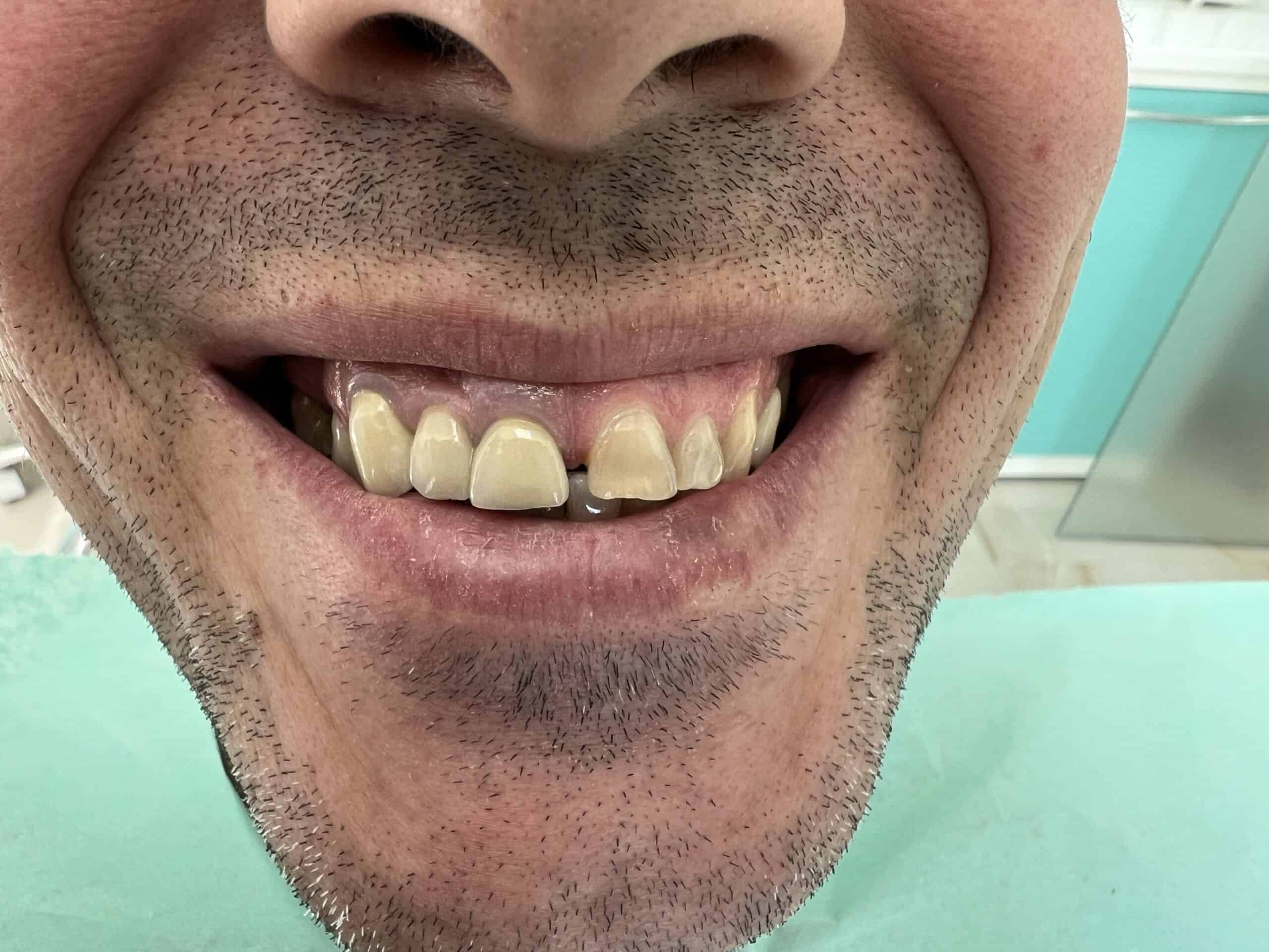 patient results before and after dental crowns in Albania