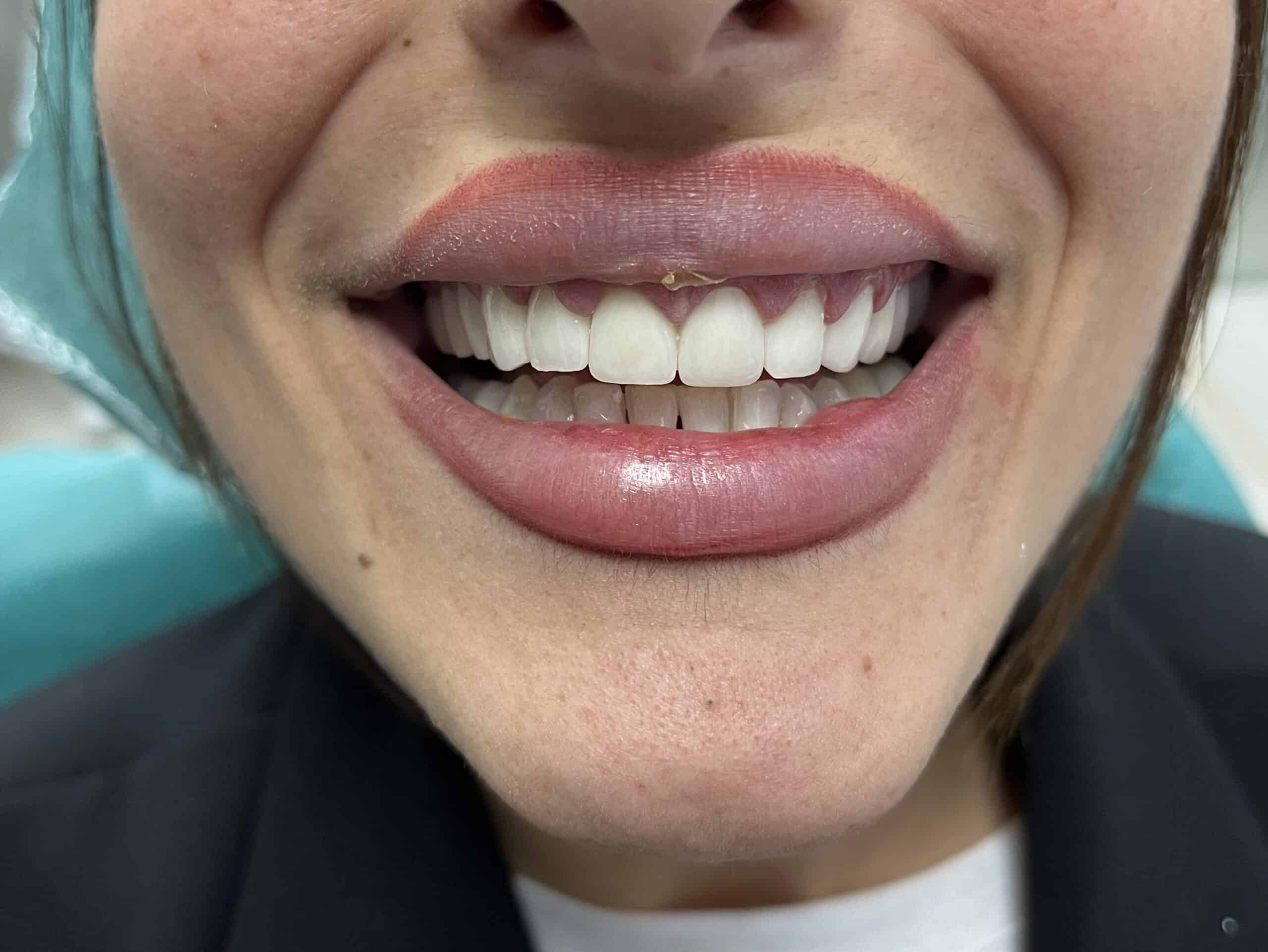 before and after dental veneers in albania