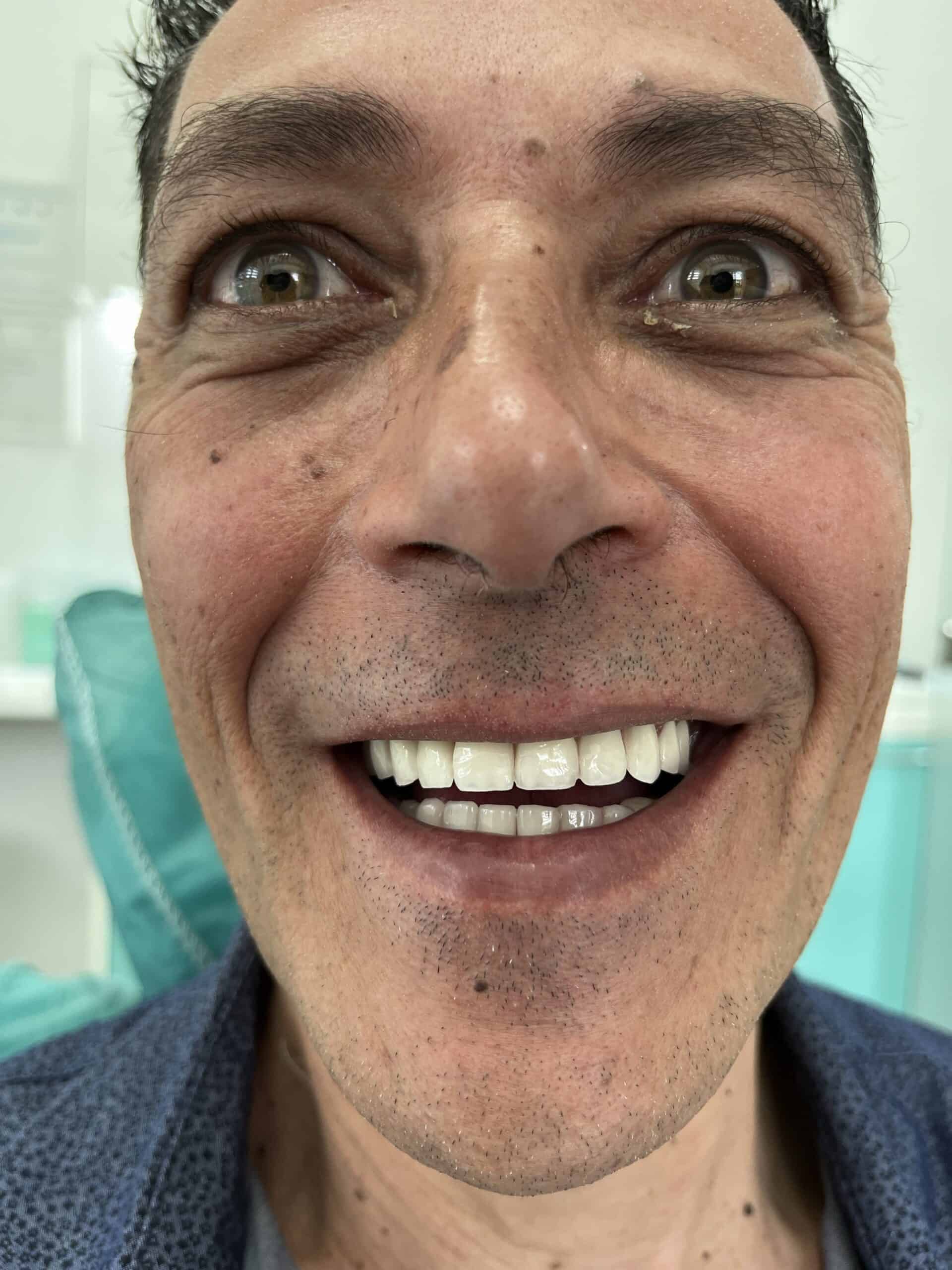 before and after dental imlants in Albania