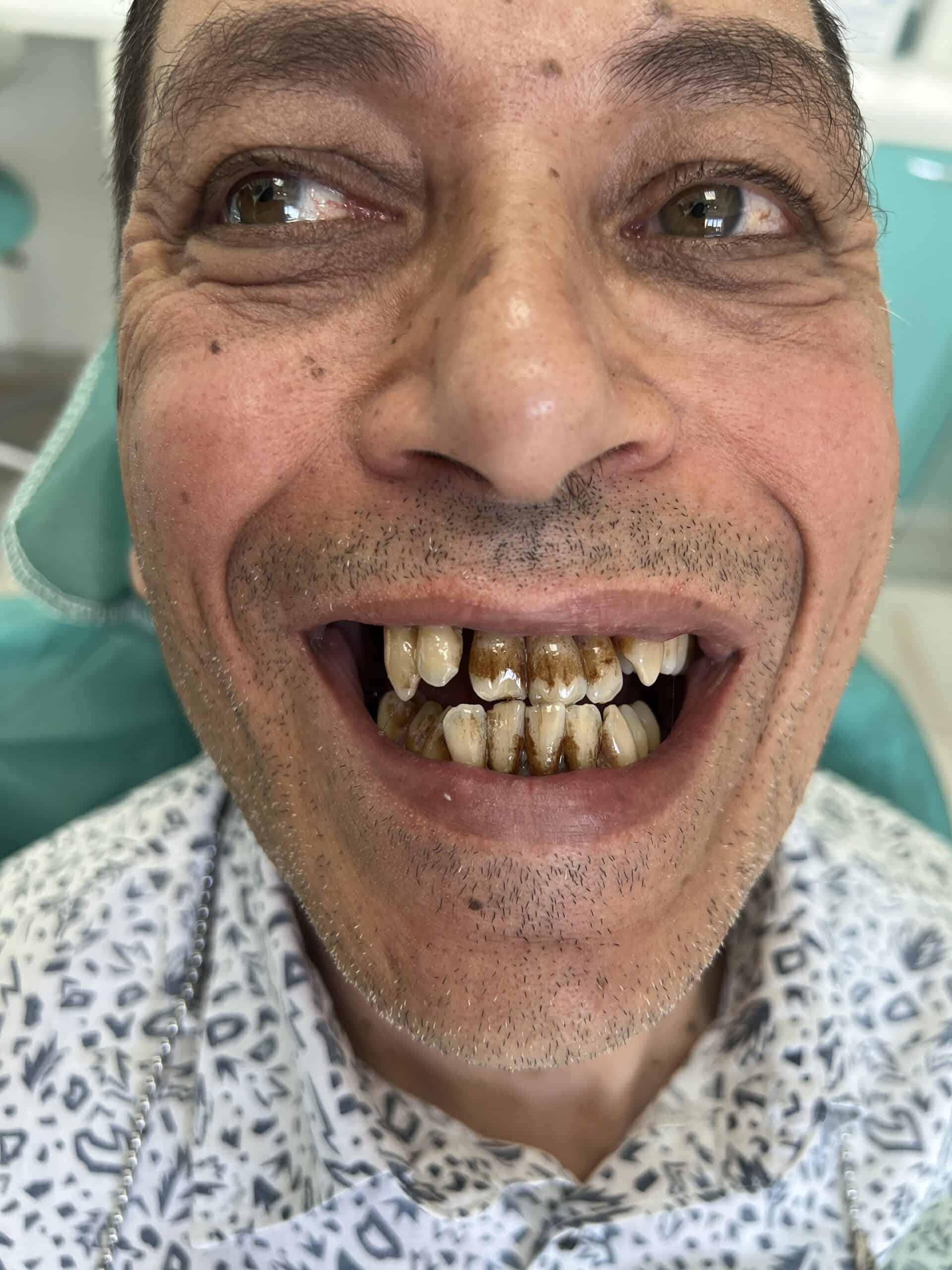 before and after dental imlants in Albania