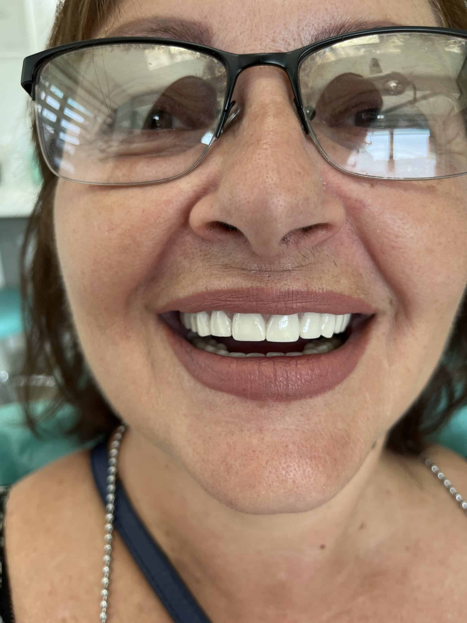 before and after dental crowns in albania