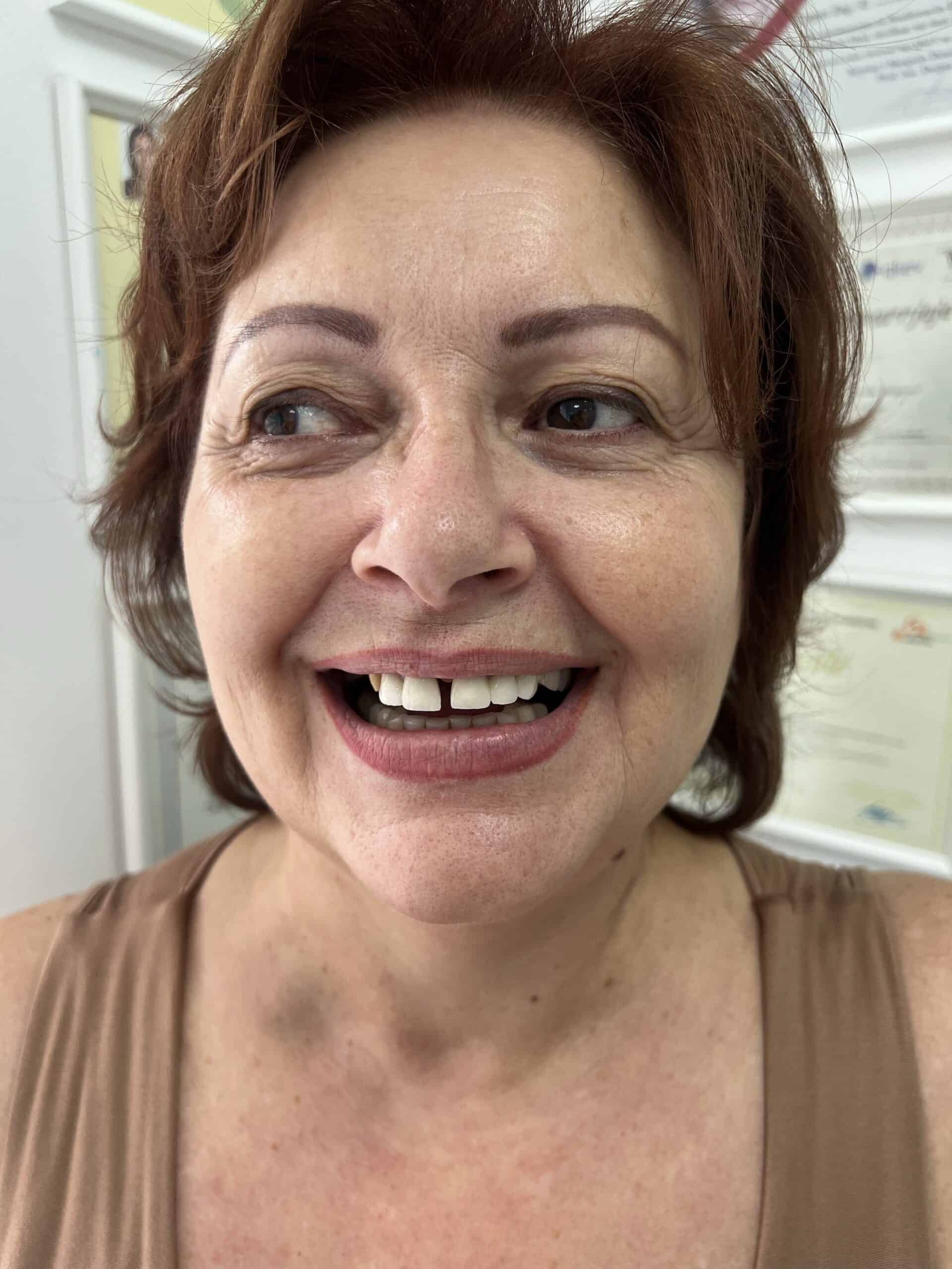 before and after dental crowns in albania
