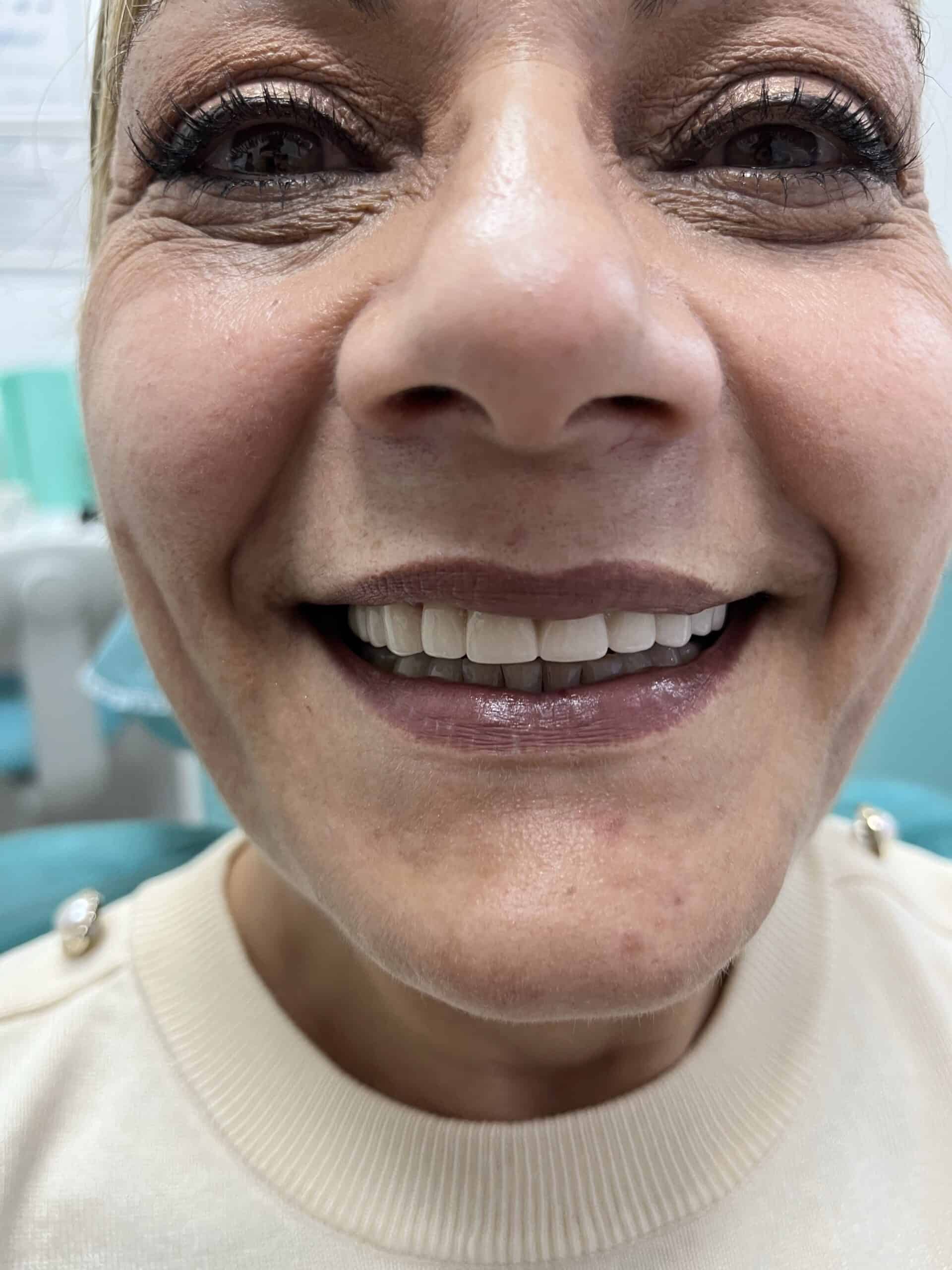 real results before and after dental crowns in Albania