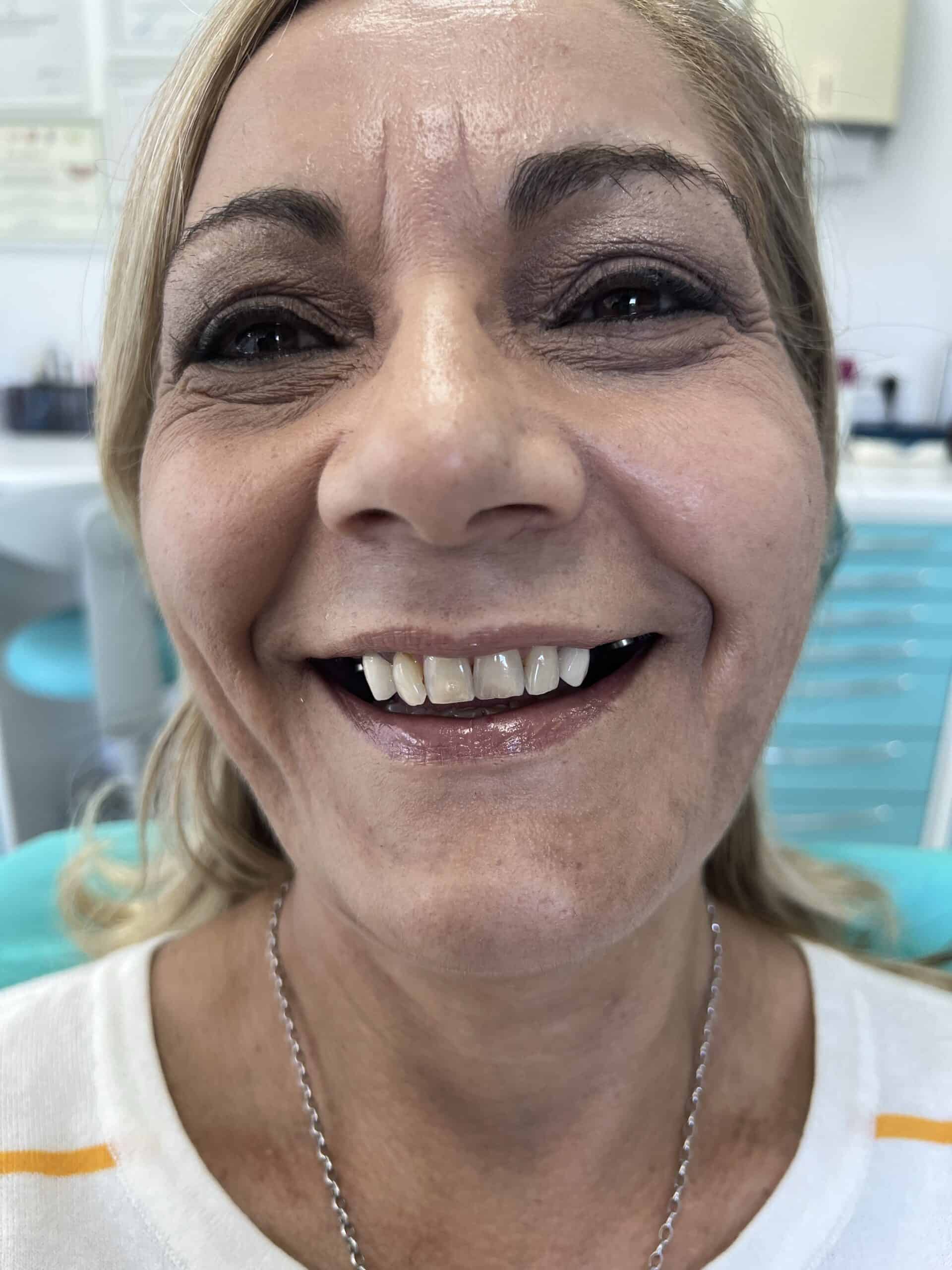 real photos before and after dental crowns in Albania