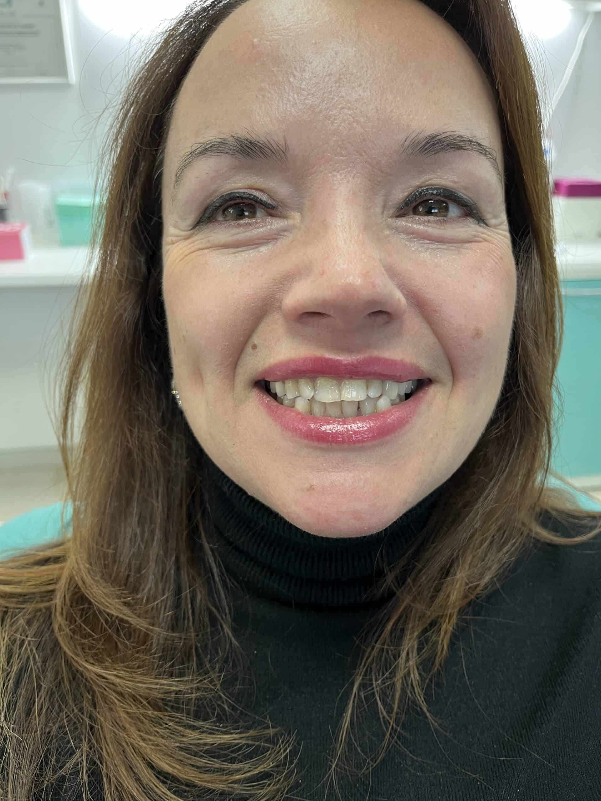 before and after dental veneers in albania