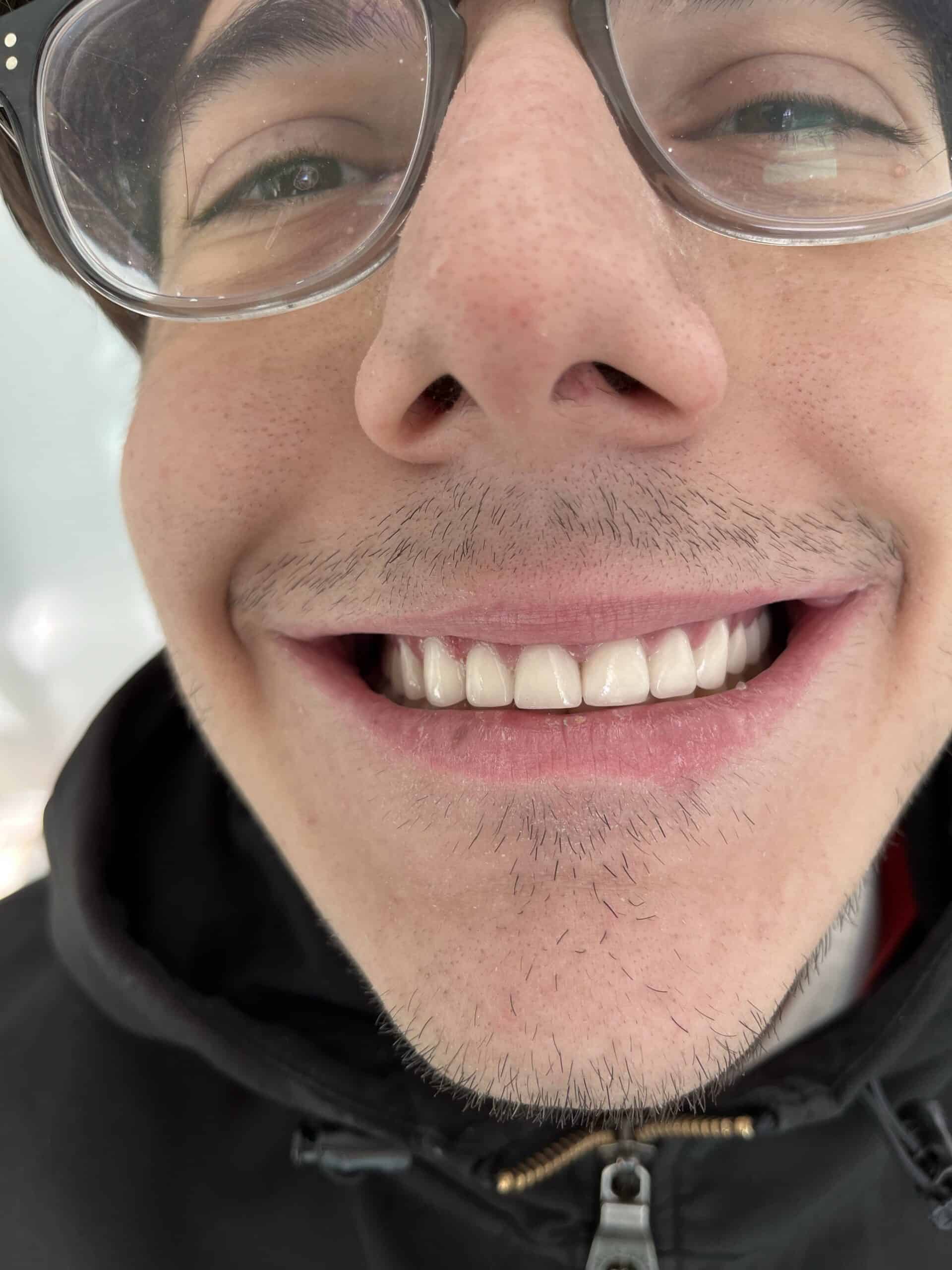 real results before and after dental crowns in Albania