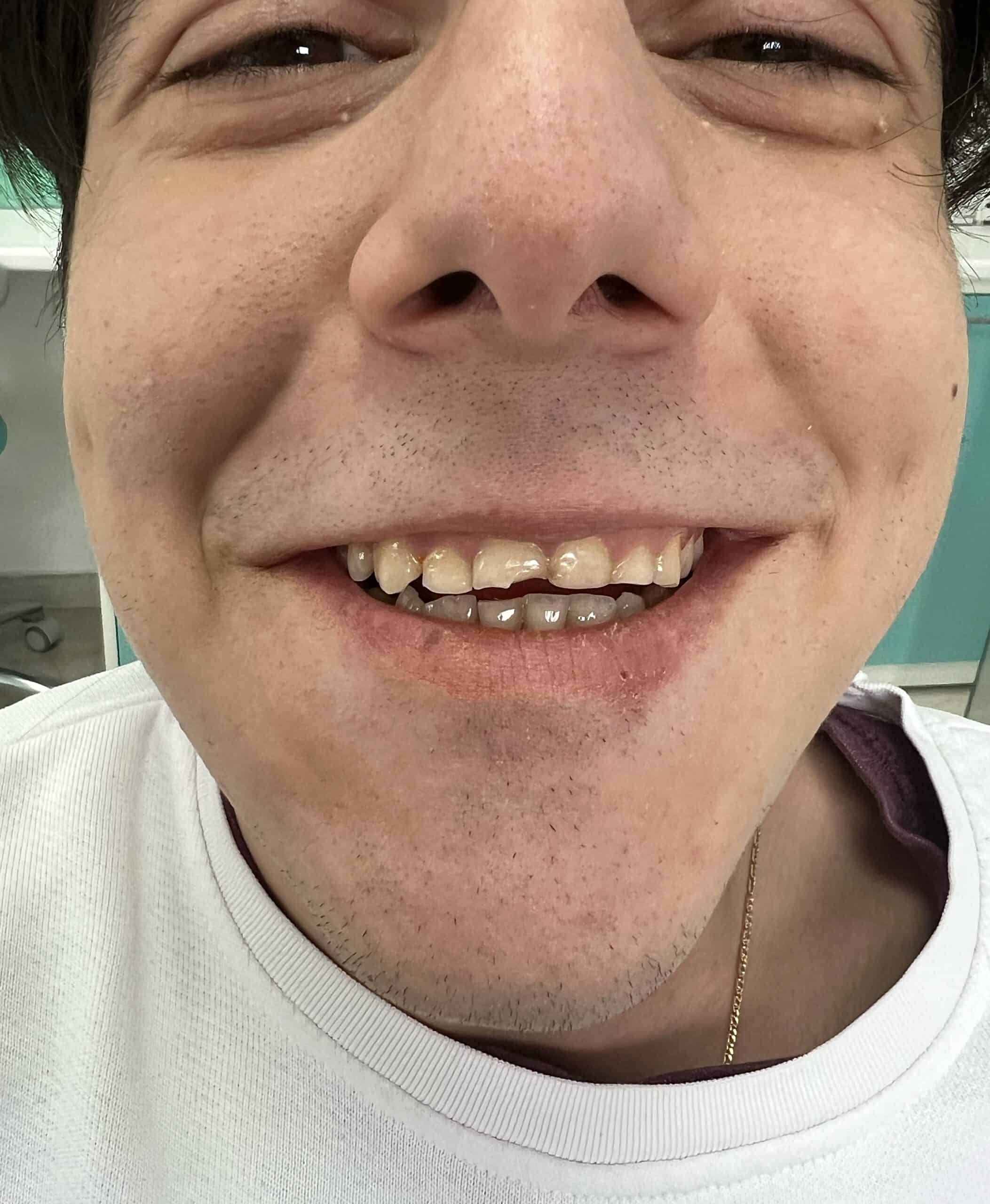 real results before and after dental crowns in Albania