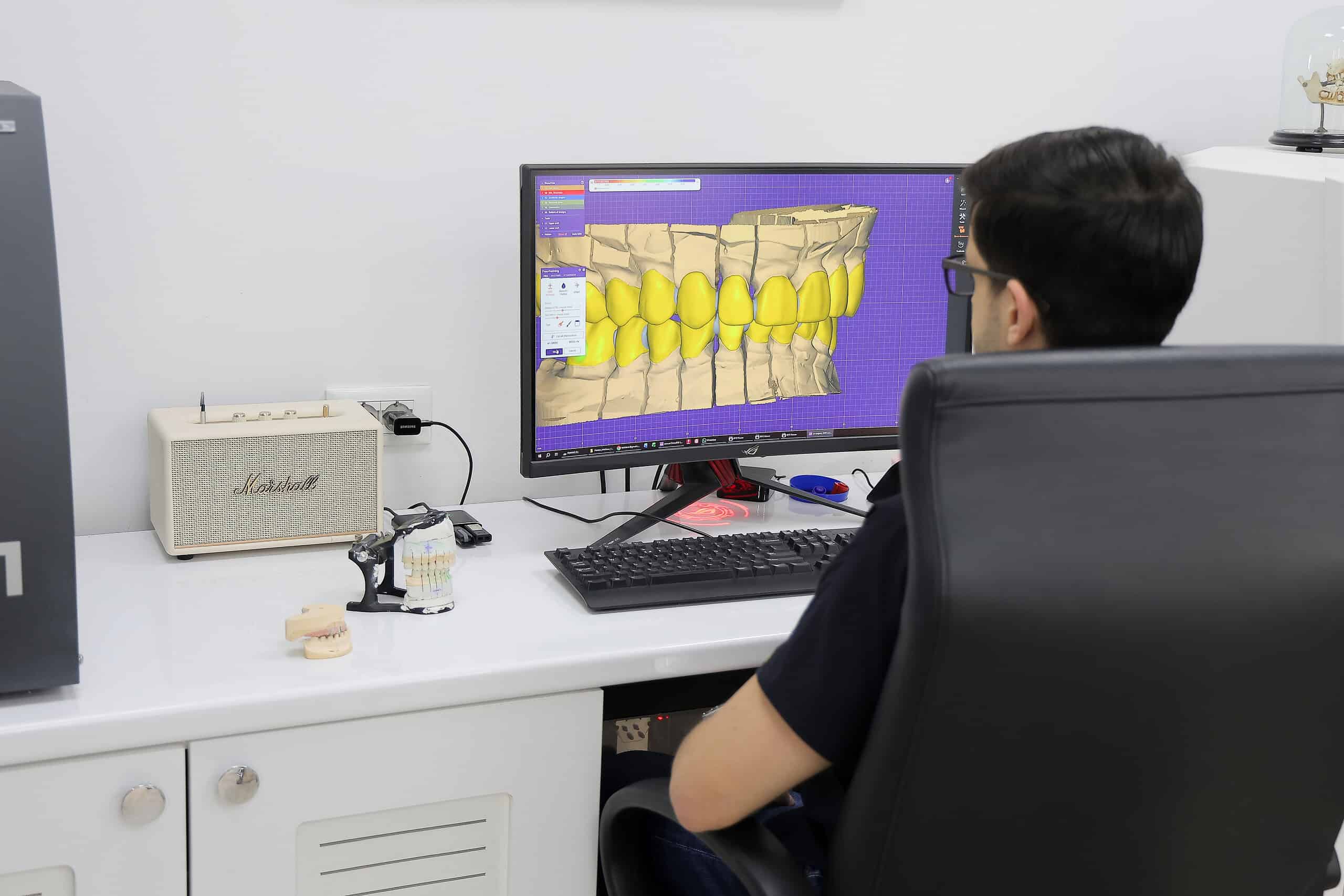 Digital dental impression scan of teeth and gums displayed on monitor.