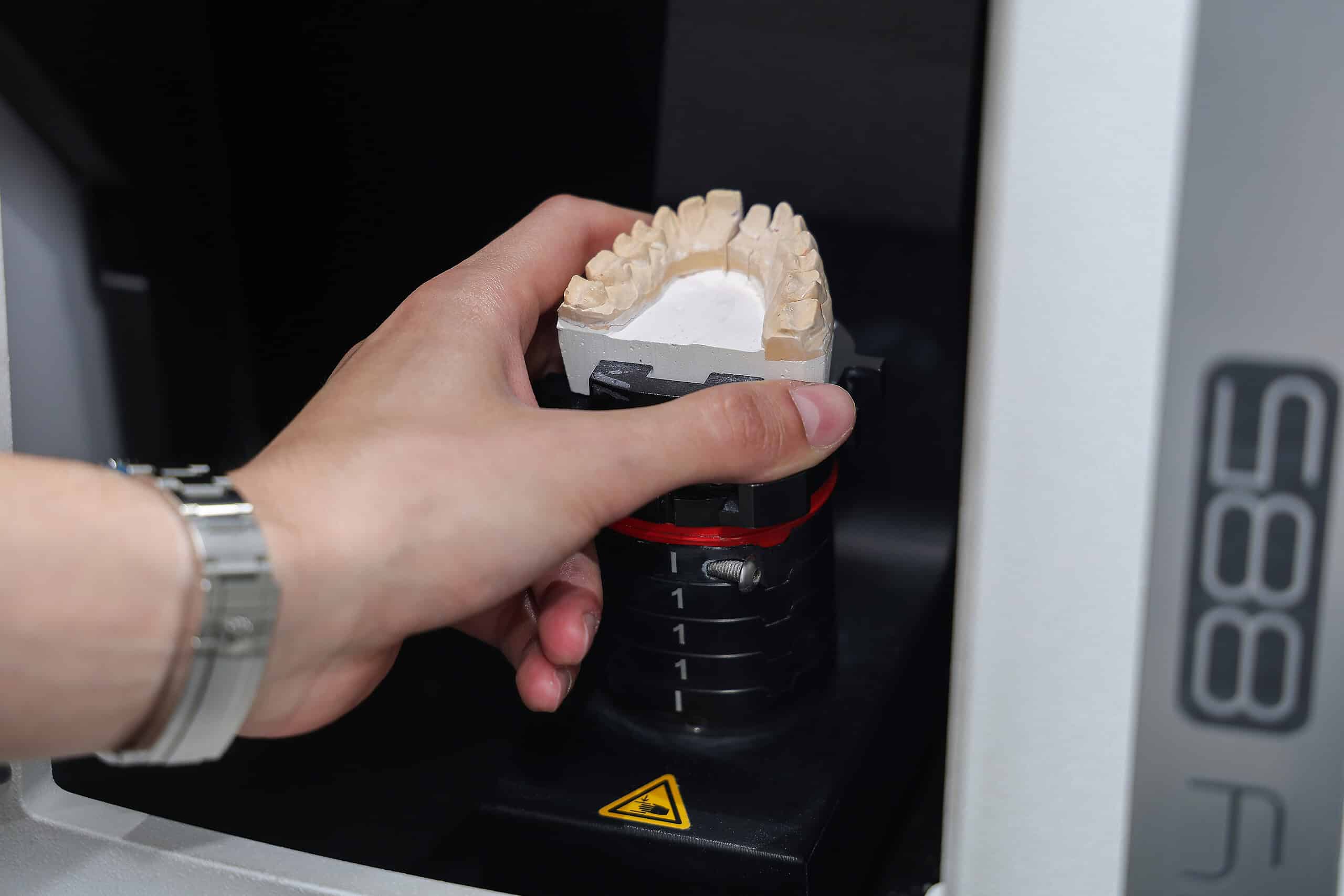 Digital dental impression scanning for accurate tooth modeling.