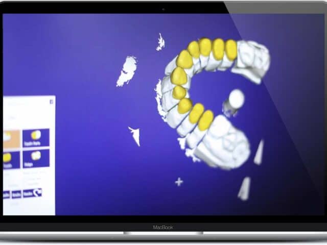 3D dental impression scan for accurate teeth modeling and treatment planning.