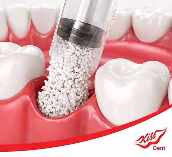 bone grafting for dental implants with little bone