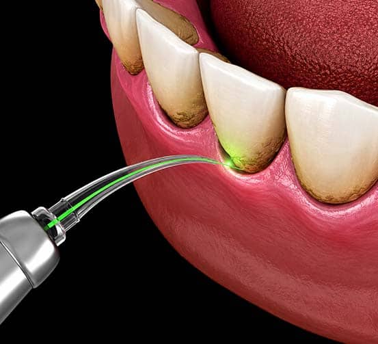 Pastrimi dentar me laser për heqjen e pllakës dhe përmirësimin e shëndetit oral.