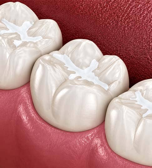 vuloja parandaluese dentare në Shqipëri